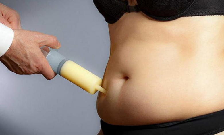 Liposuction Operasyonu Sonrası Kilo Verme Nasıl Olur?